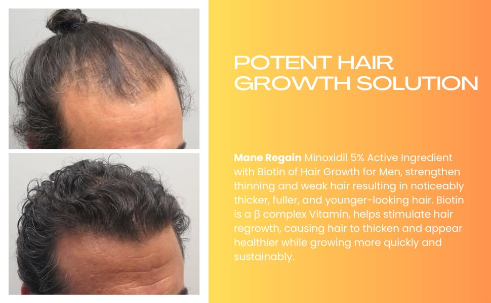 Minoxidil Topical Solution USP 5%, Extra Strength Hair Regrowth Treatment for Men, 1 Month Supply, Unscented, 2 Fl Oz (1 Pack)