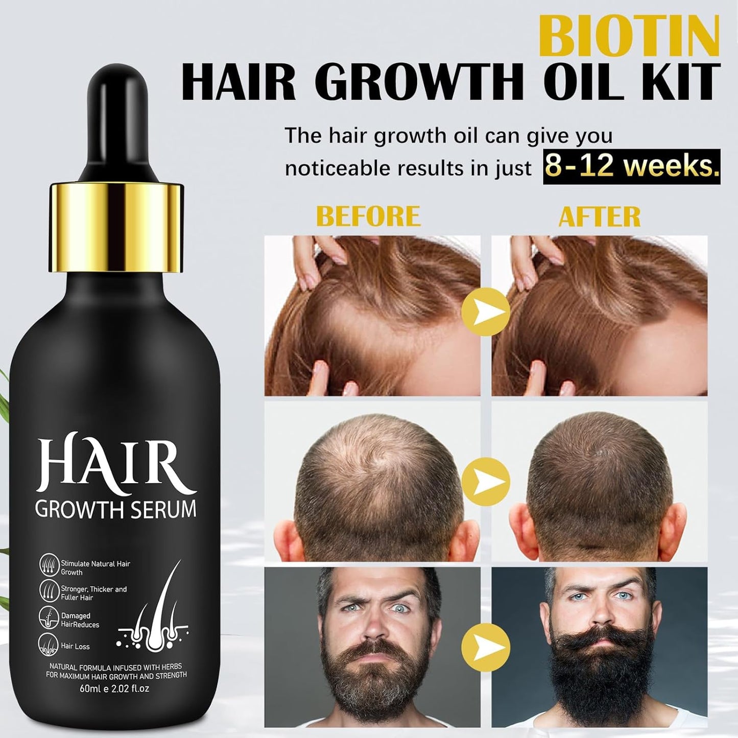 Hair Growth Oil and Derma Roller 0.25mm Scalp Kit, Natural Serum With Biotin, Microneedle Beard Roller for Thicker Longer Fuller Hair and Beard - 2.02 Oz