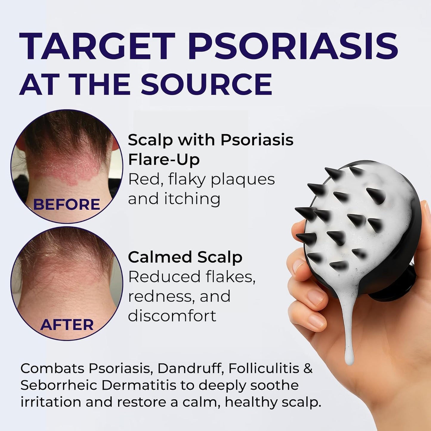 Scalp Psoriasis Shampoo, Flakes Shampoo Anti Dandruff, Itchy Scalp Treatment for Seborrheic Dermatitis & Folliculitis, Anti Fungal, Medicated Solution for Itchy, Flaky & Dry Hairs (Pack of 2)