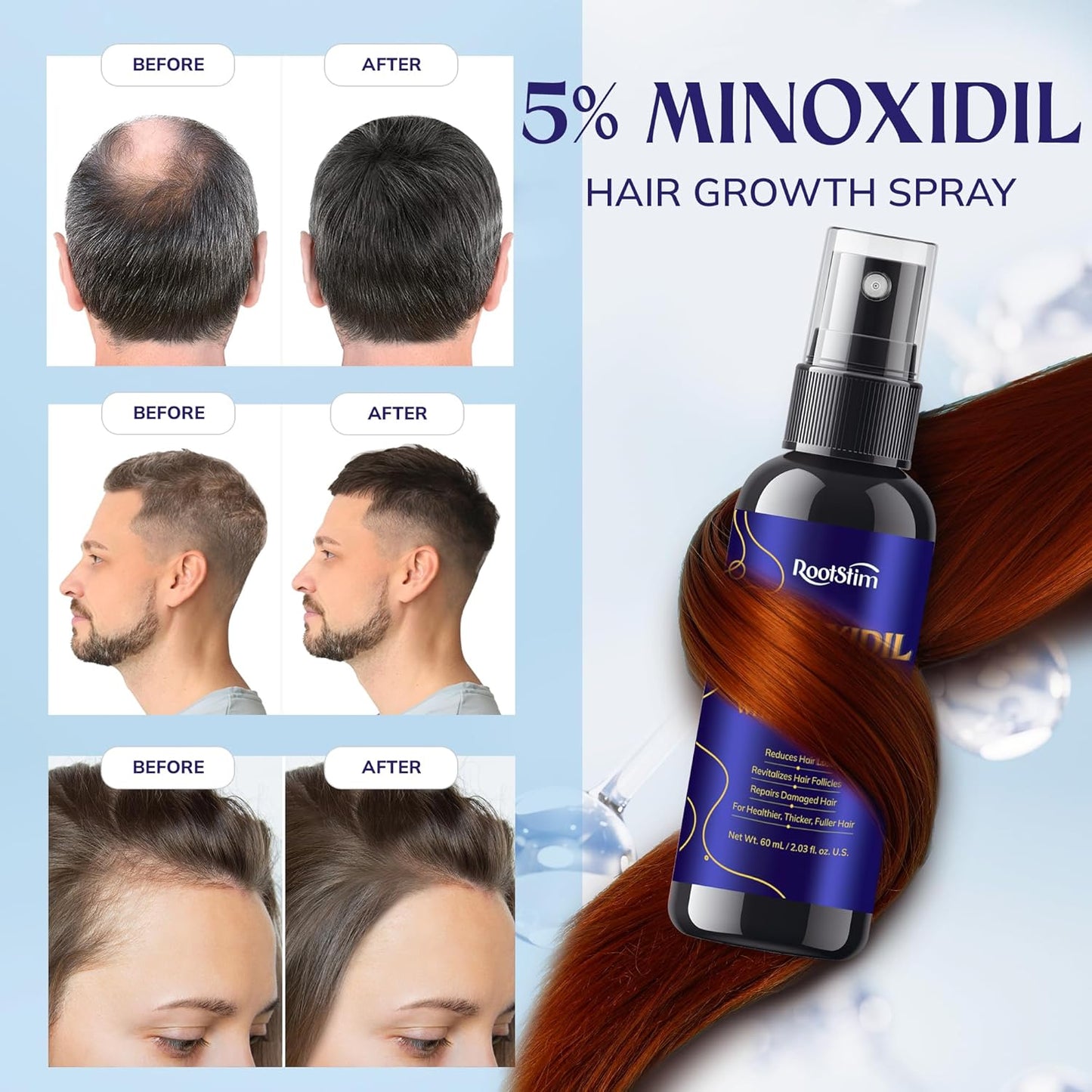 5% Minoxidil Hair Growth for Men and Women: 2-Pack Extra Strength Minoxidil Hair Loss Treatment Serum with Rosemary for Faster Stronger Thicker Hair Growth - 60ML Each